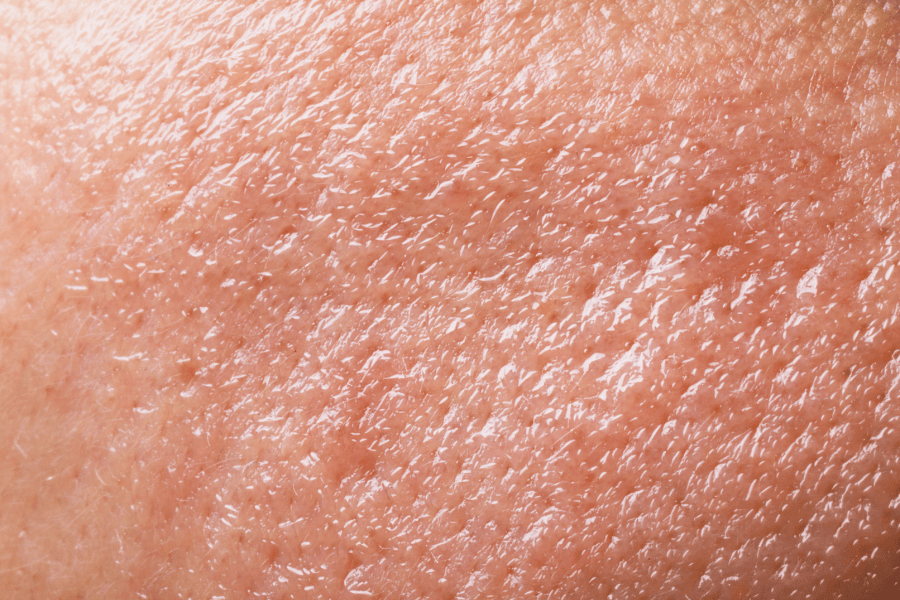 inflamed skin