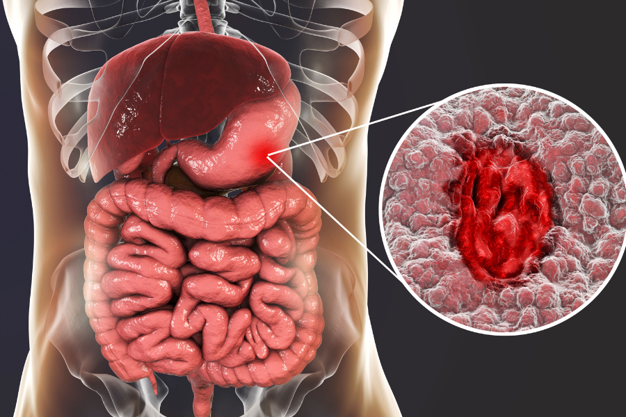gut-health inflammation