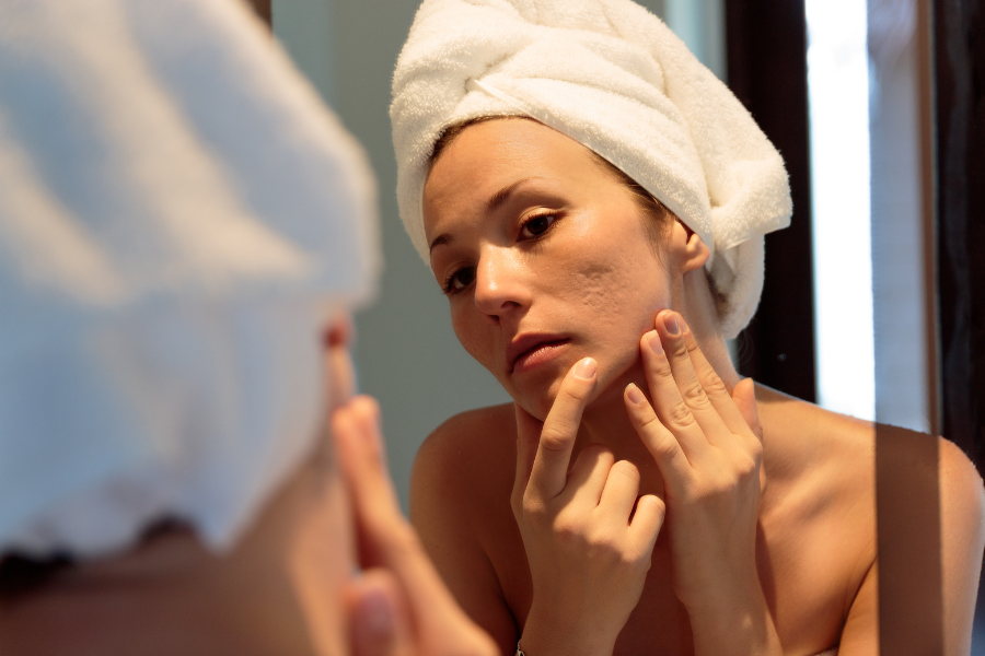 menopause acne