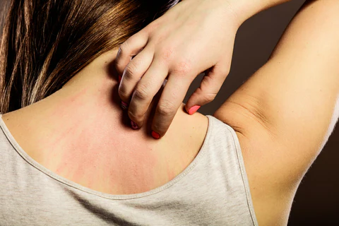 skin rash